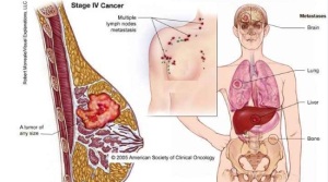obat kanker payudara herbal